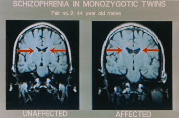 MRI Scans and Schizophrenia MRI Scans and Schizophrenia