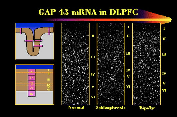 Schizophrenia and mRNA Schizophrenia and mRNA