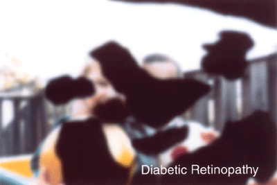Simulated Vision with Advanced Diabetic Retinopathy Simulated Vision with Advanced Diabetic Retinopathy